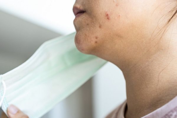 7 Cara Mencegah Iritasi dari Masker di Area Dagu