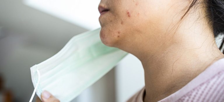 7 Cara Mencegah Iritasi dari Masker di Area Dagu