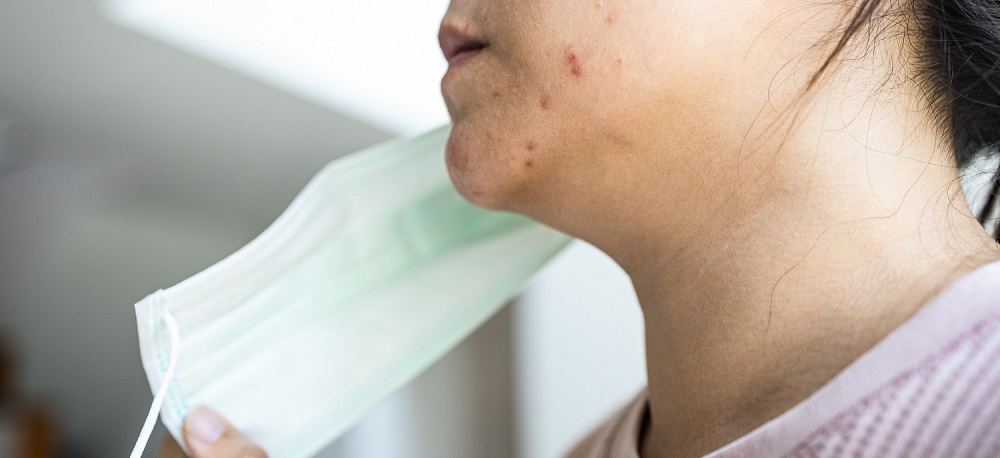 7 Cara Mencegah Iritasi dari Masker di Area Dagu
