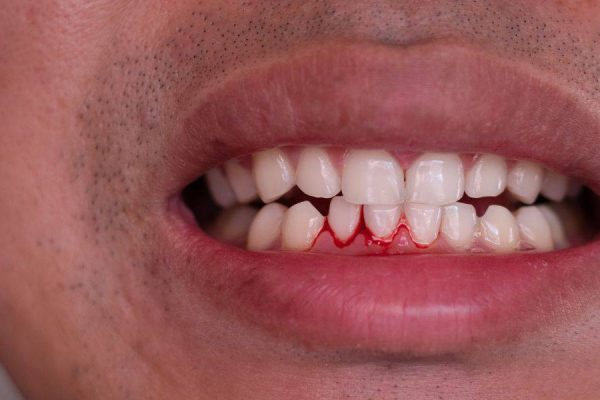 7 Penyebab Gusi Mudah Berdarah yang Jarang Disadari