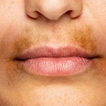 5 Cara Menghilangkan Noda Gelap di Bibir