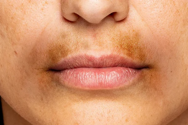 5 Cara Menghilangkan Noda Gelap di Bibir