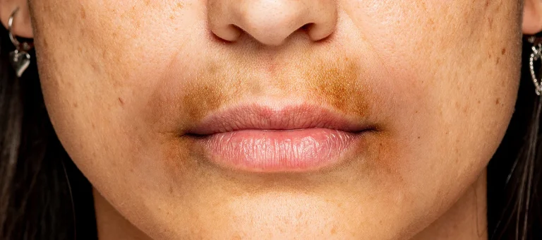 5 Cara Menghilangkan Noda Gelap di Bibir
