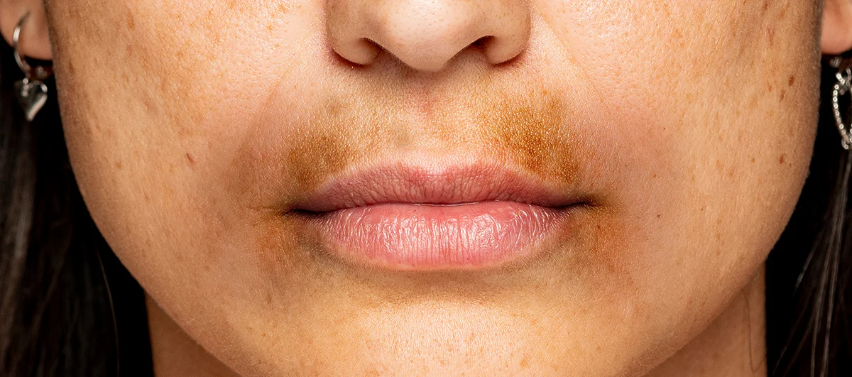 5 Cara Menghilangkan Noda Gelap di Bibir