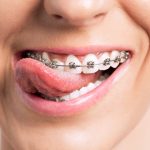 10 Tips Perawatan Gusi untuk Pengguna Behel