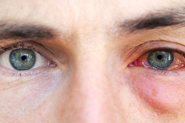 7 Cara Menghindari Kerusakan Retina Sejak Dini
