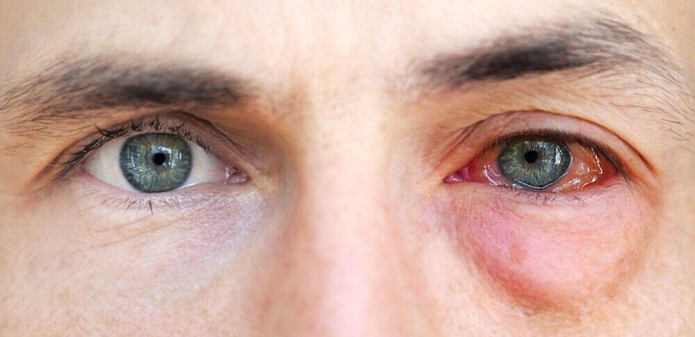 7 Cara Menghindari Kerusakan Retina Sejak Dini