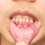 10 Hal yang Wajib Dihindari Saat Bibir Sedang Luka