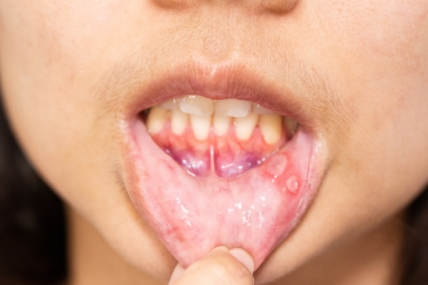 10 Hal yang Wajib Dihindari Saat Bibir Sedang Luka