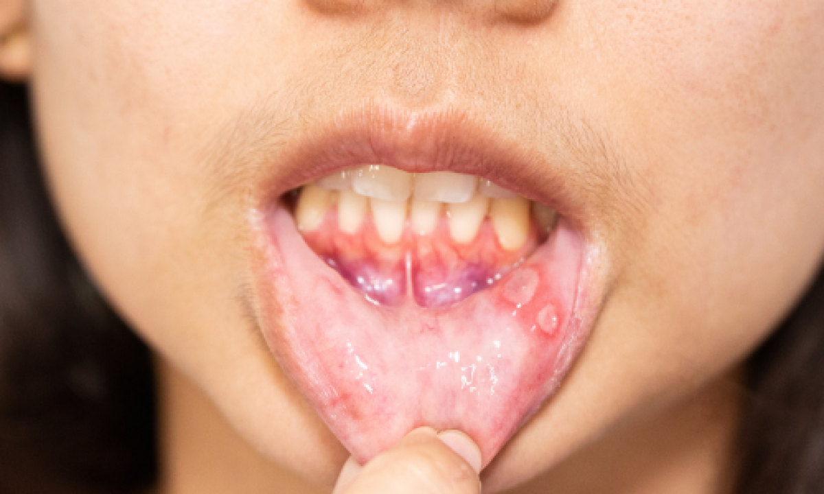 10 Hal yang Wajib Dihindari Saat Bibir Sedang Luka