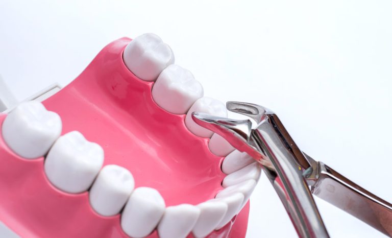 10 Cara Perawatan Gigi Setelah Cabut Gigi