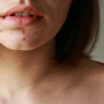 7 Langkah Mencegah Jerawat Hormonal di Area Dagu